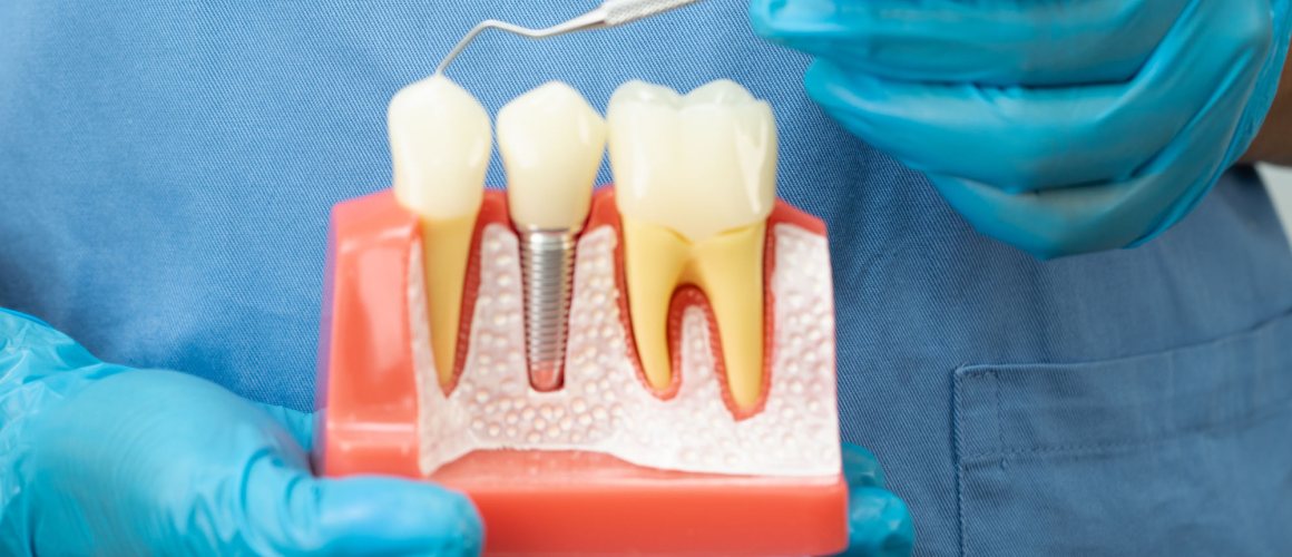 A cross-section dental teaching model held in blue-gloved hands, showing a titanium implant seated in the jawbone between two natural teeth, with a periodontal probe alongside